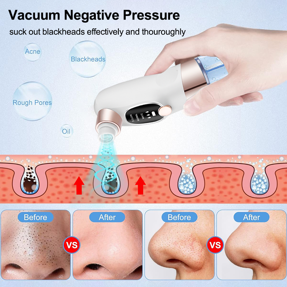 Electric Blackhead Remover Ski – Embroidery Removal recenzja i cena
